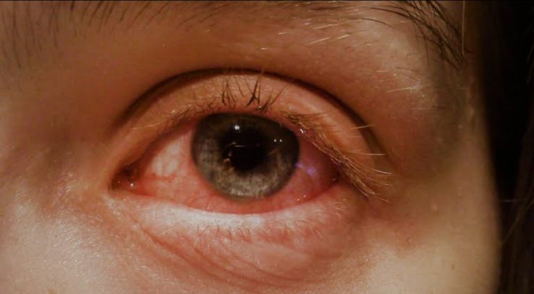 Pink Eye: Causes, Precautions And Treatment